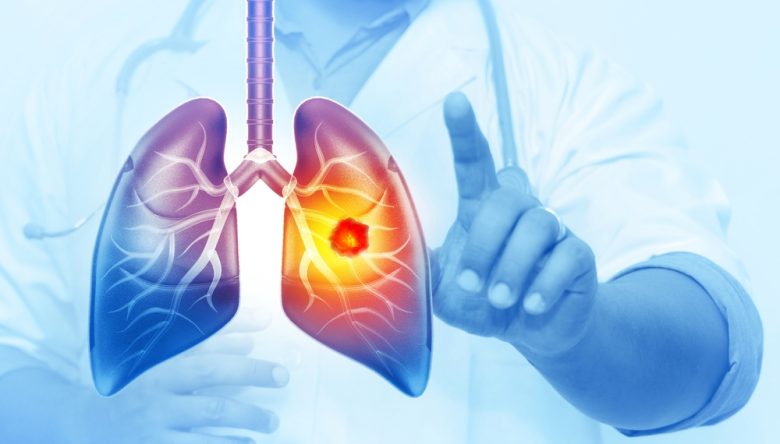HER YIL 25 BİN AKCİĞER KANSERİ VAKASI ÖNLENEBİLİR